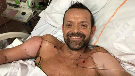Felix Greatarsson recibió el primer trasplante doble de brazos en el mundo