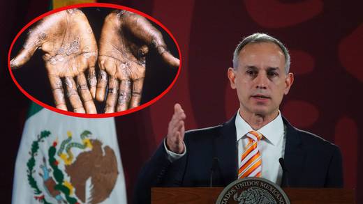 Hugo López-Gatell no aplica sus propias enseñanzas para controlar la viruela del mono
