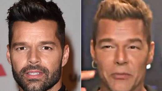 Ricky Martin habría sufrido reacción alérgica en su rostro