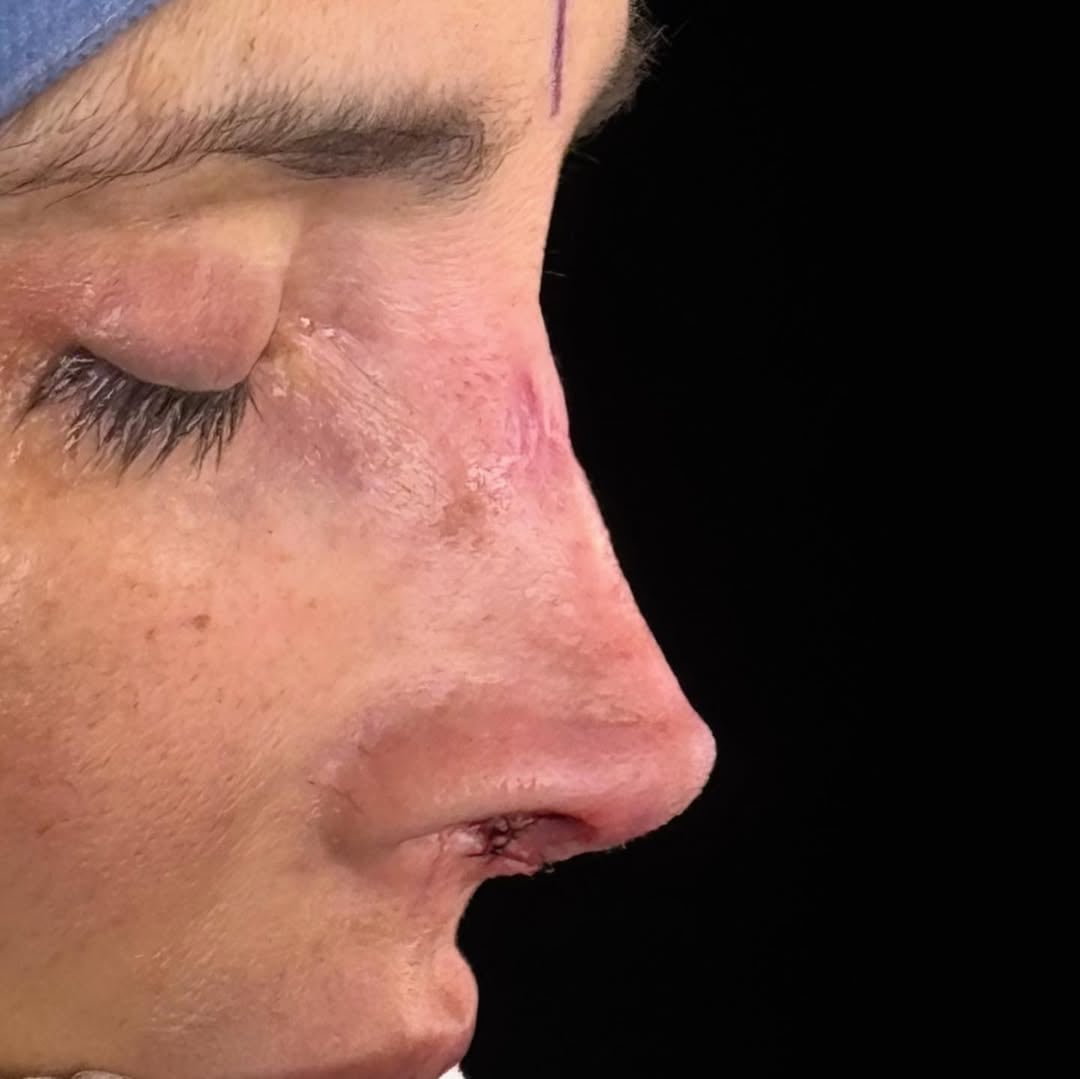 Dorismar se somete a una quinta cirugía de nariz tras sufrir negligencia