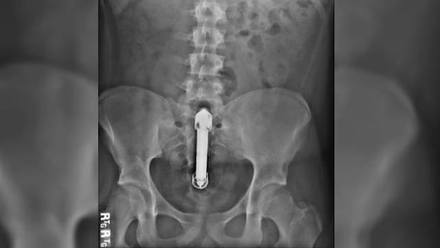 Hombre de 50 años falleció por culpa de un vibrador y por no ir al doctor.