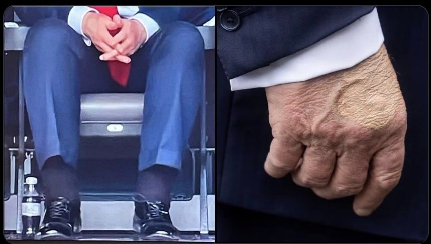 Donald Trump es diagnosticado con insuficiencia venosa crónica