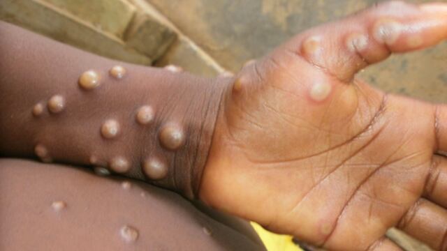 Viruela de los monos