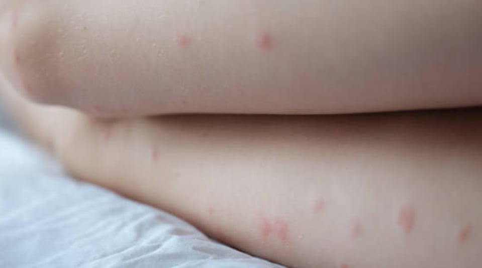 Gripe del tomate: qué es, síntomas y cómo se contagia