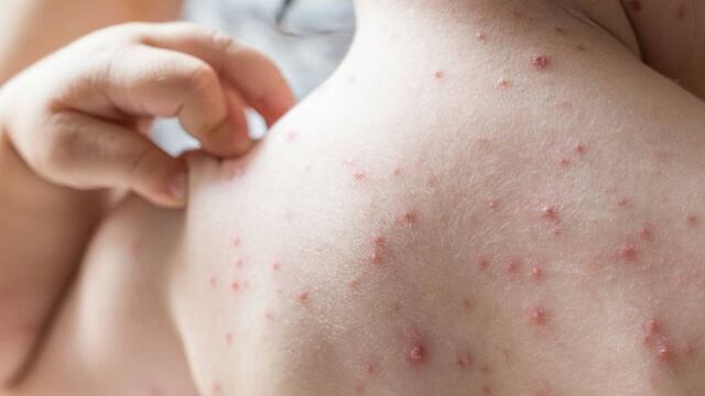 Los 9 síntomas de la gripe del tomate que debes conocer para actuar rápido/internet