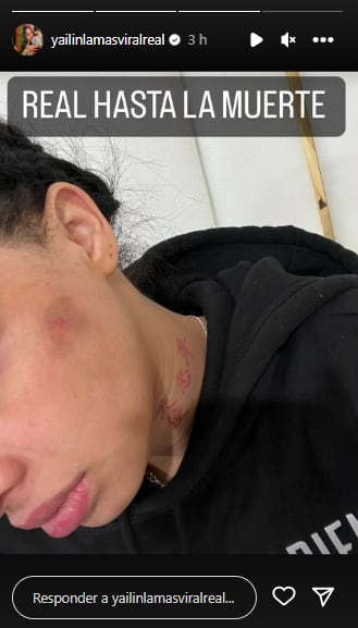 Yailin La Más Viral muestra golpe en la cara