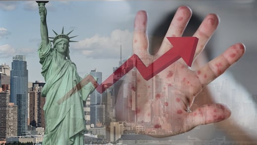 Sarampión se dispara en Nueva York: declaran emergencia estatal por 108 casos