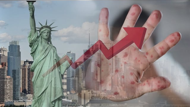 Sarampión se dispara en Nueva York