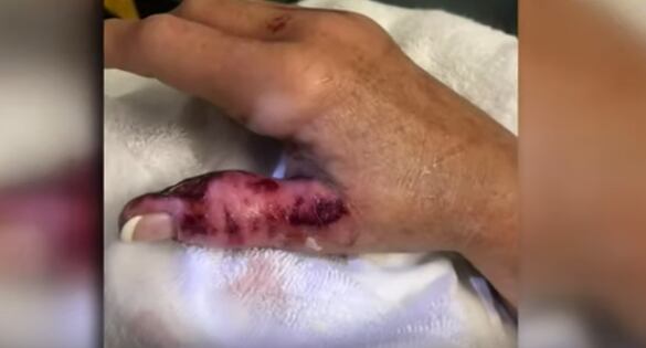 El resultado de la bacteria come carne.