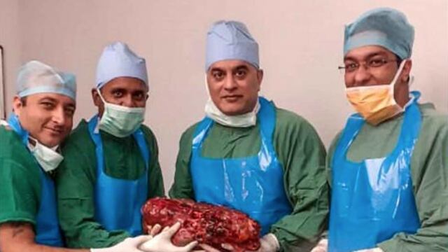 Extraen gigante riñón de 7.4 kilos a hombre de la India.