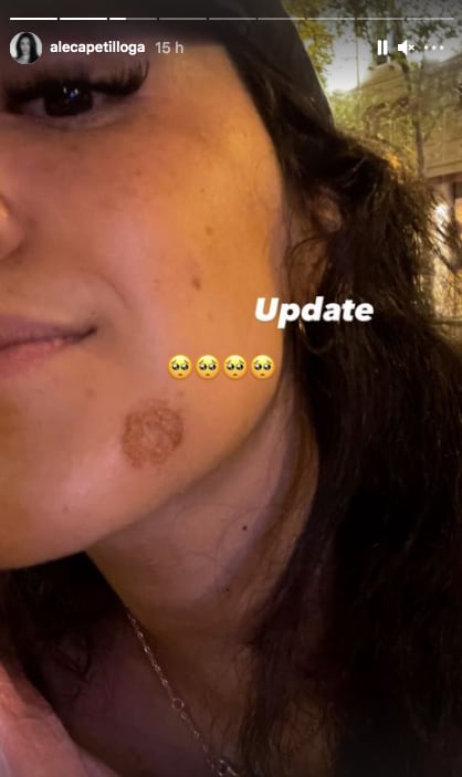 Alejandra Capetillo sufre quemadura en la cara