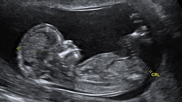 Ultrasonido de un bebé