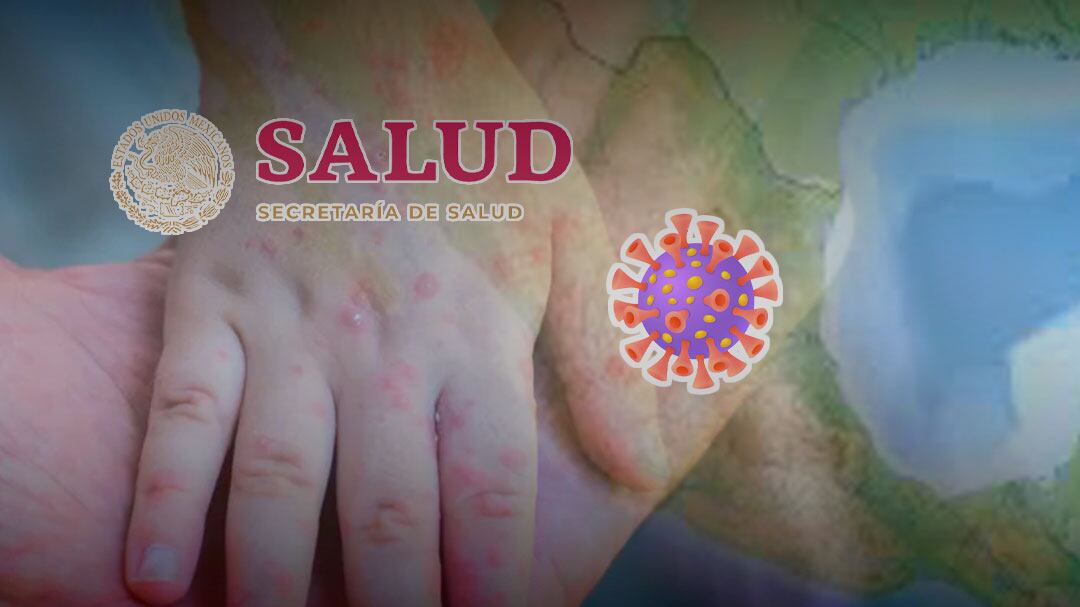 Secretaría de Salud confirma brotes de sarampión en todo México