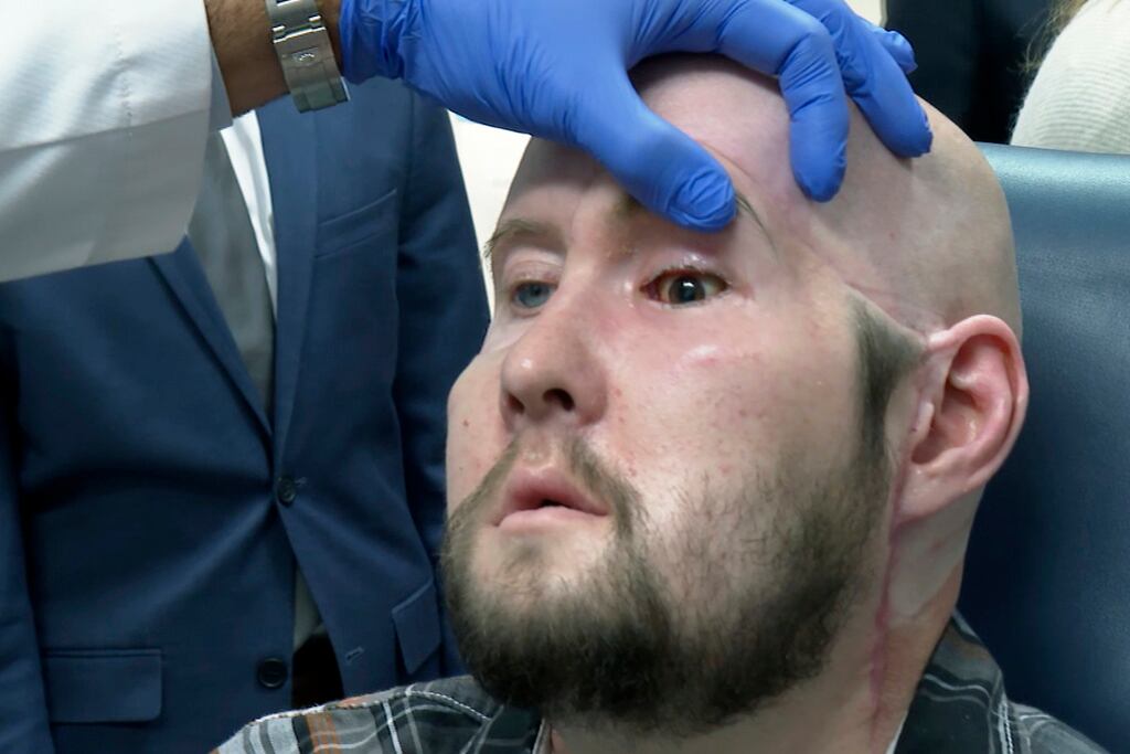 Aaron James, receptor del primer trasplante de ojo completo
