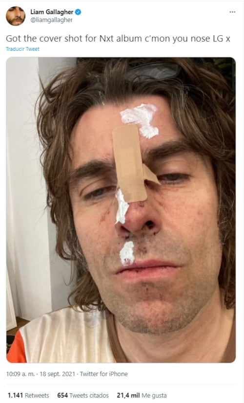 Liam Gallagher sufre accidente