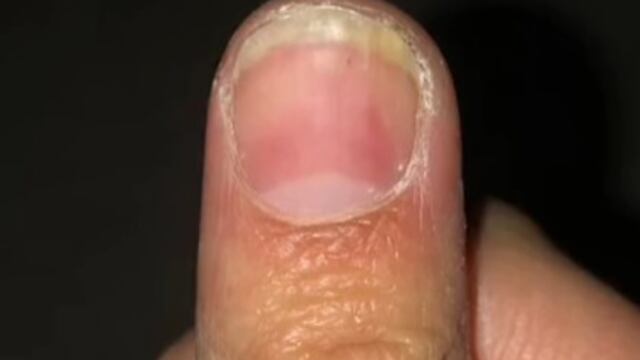 Uña volviendo a crecer