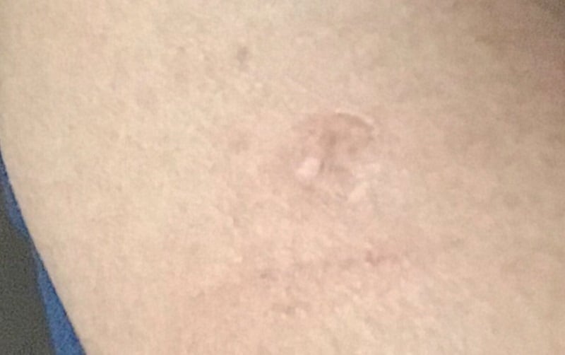 Cicatriz de vacuna BCG