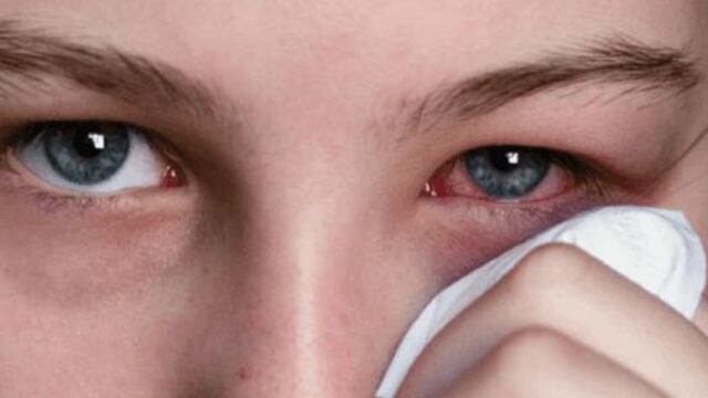 Conjuntivitis por Covid-19