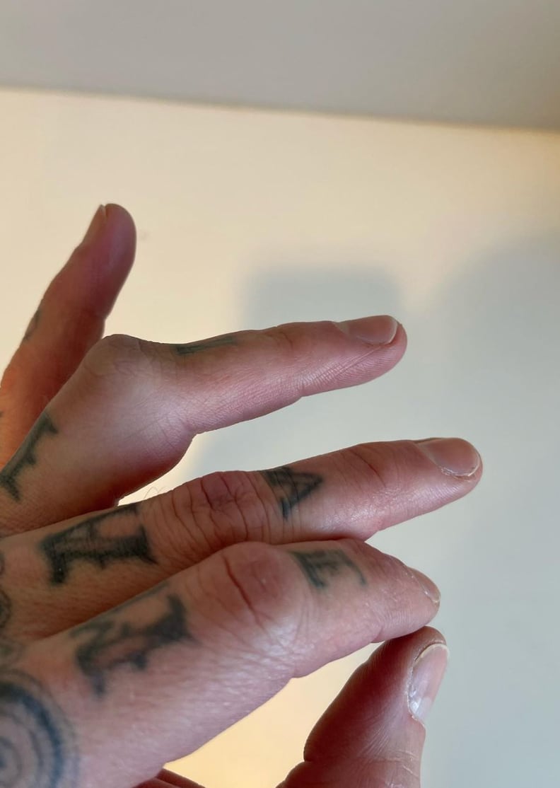 Lesión Travis Barker