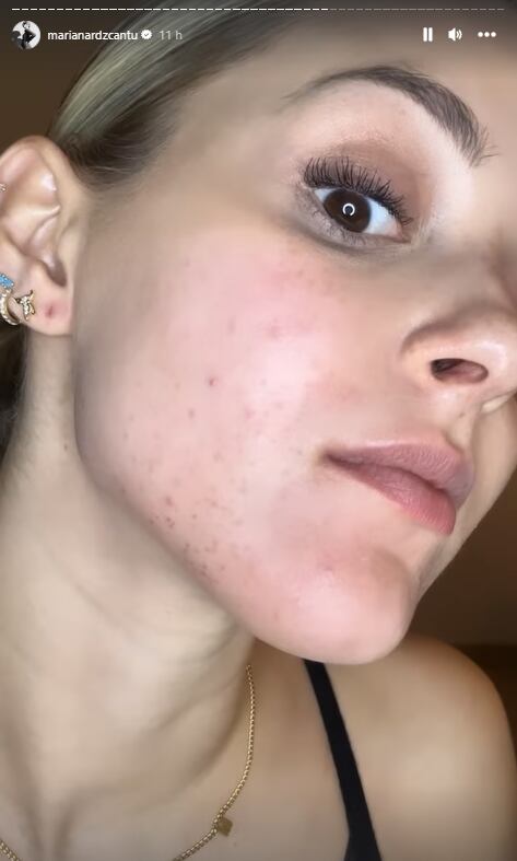 Mariana Rodríguez muestra los granos rojos en su cara.