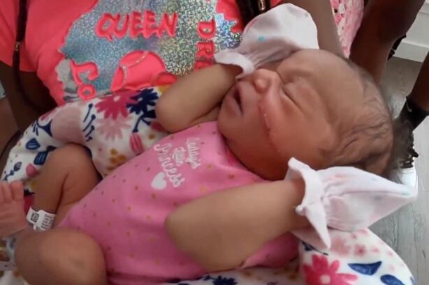 Bebé, su cara fue cortada en una cesárea