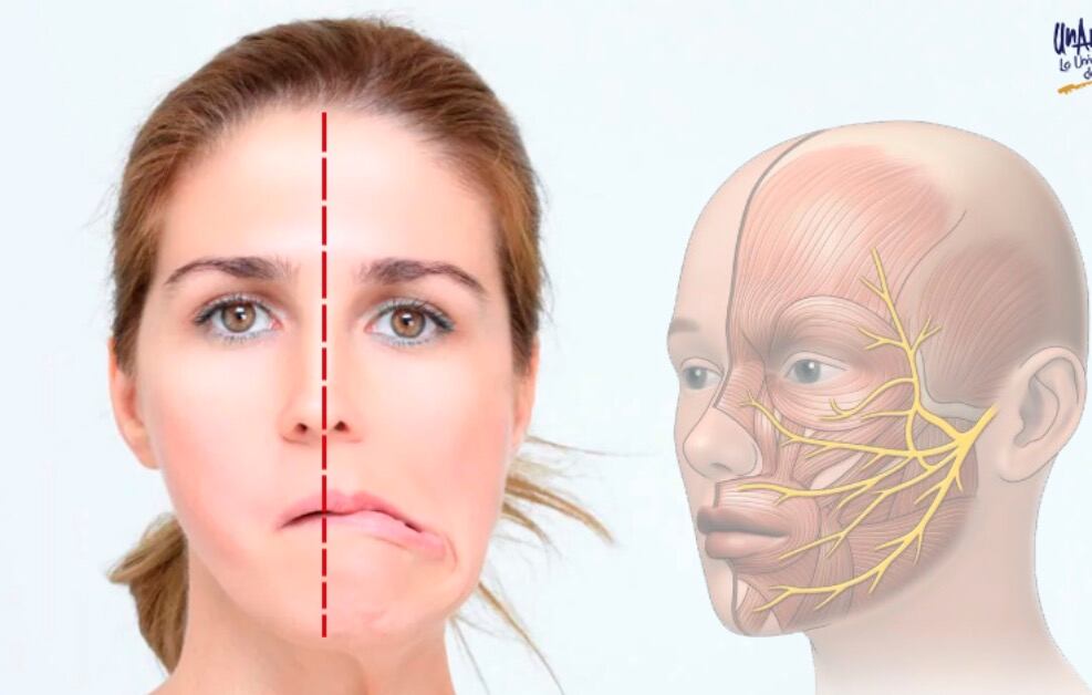 Parálisis facial