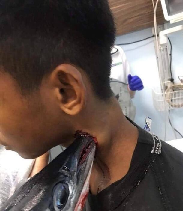 Joven con pez espada atravesado en el cuello