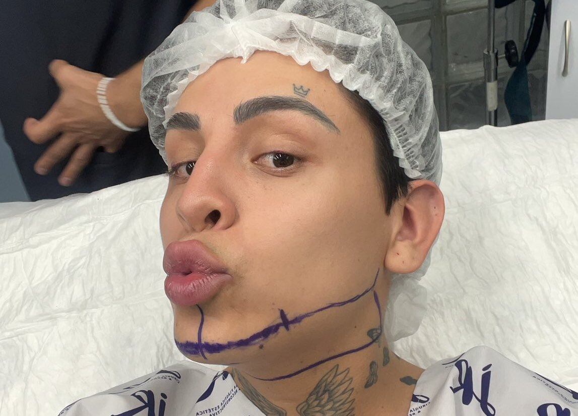 Kunno se realiza la lipopapada