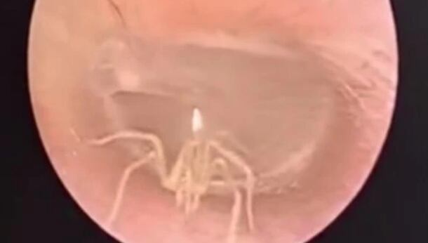 Descubren araña dentro de su oído