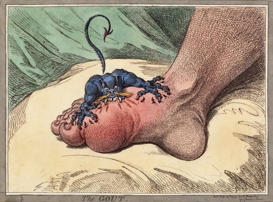 Enfermedad de la Gota