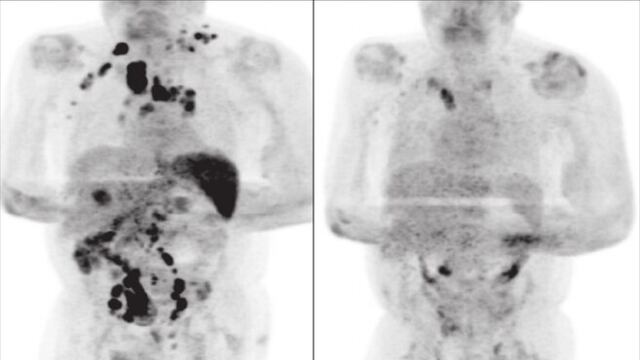 Paciente con linfoma de Hodgkin