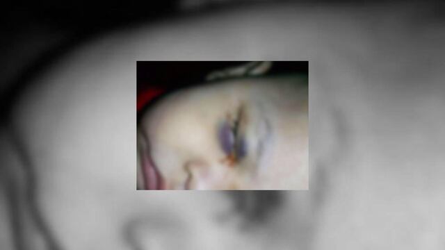 CNDH investiga caso de menor al que le fue extraído un ojo por negligencia