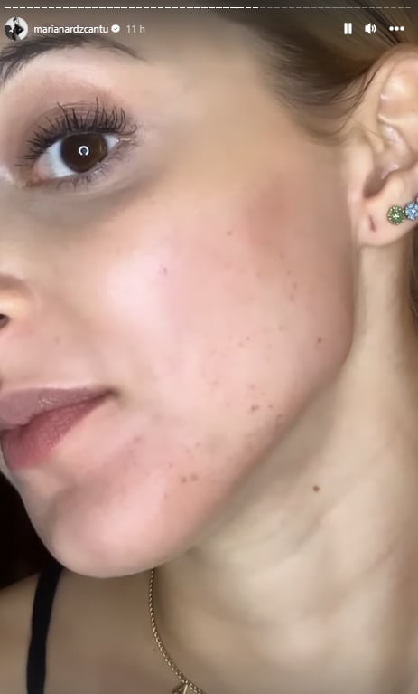 Mariana Rodríguez muestra los granos rojos en su cara.