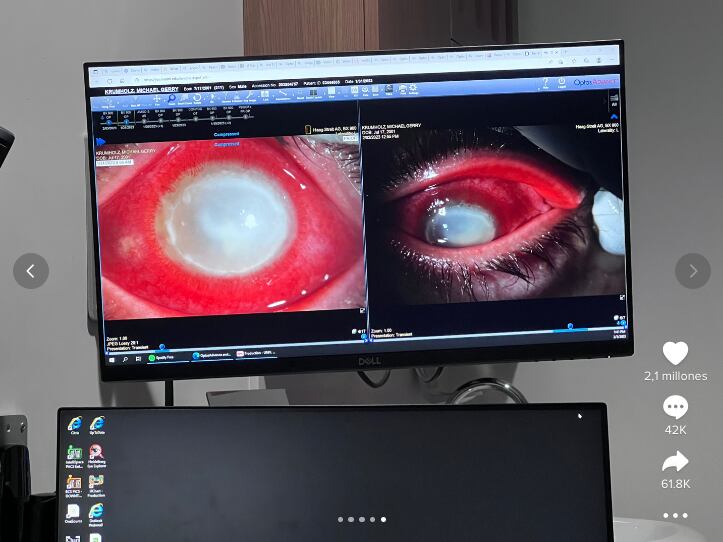 Infección en el ojo provocada por una ameba