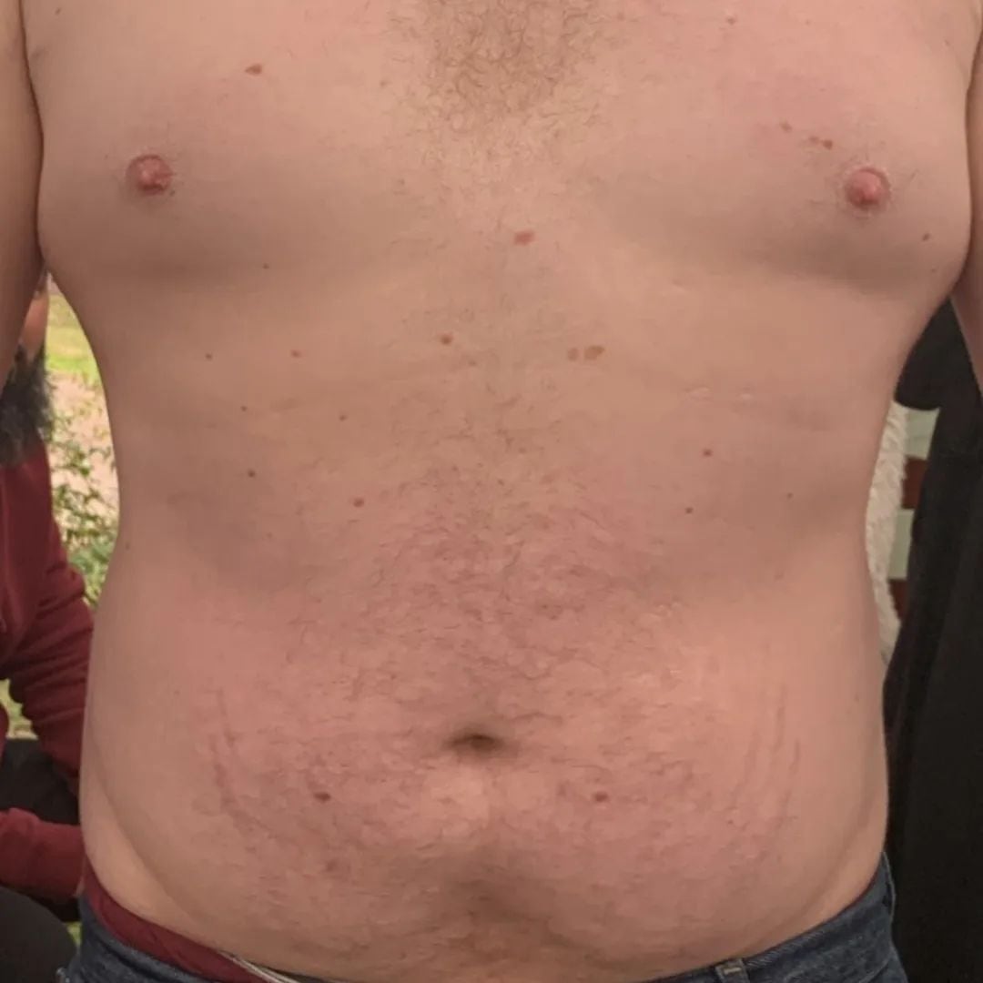 Abdomen antes del tatuaje