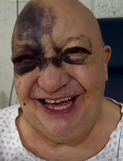 Luisd de Alba sufrió una lesión en el rostro