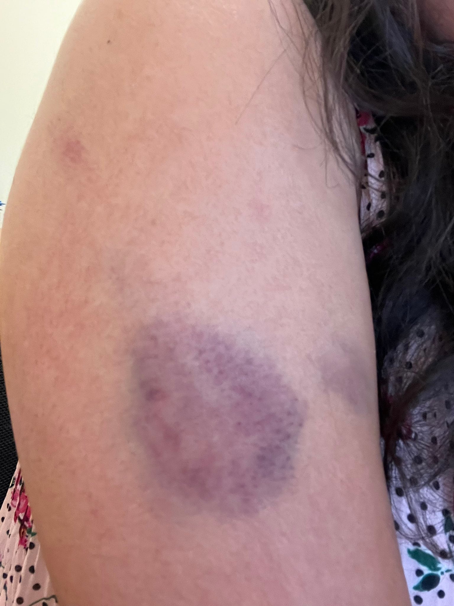 Lesiones por agresión de hombre a pareja en San Luis Potosí