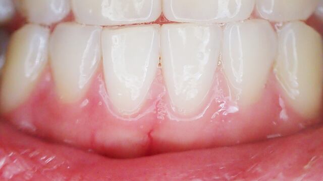 Los chicles con xilitol y sorbitol actúan como un portador de ingredientes antibacterianos