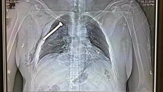 Imagen de la radiografía de uno de los heridos en los atentados con un tornillo incrustado en uno de sus pulmones.