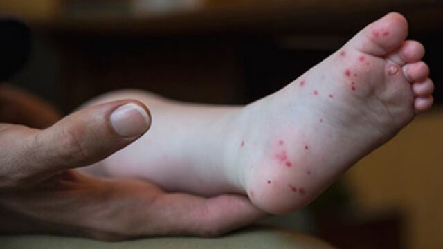 Virus Coxsackie en Hidalgo