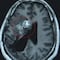 Durante 15 años, un parásito se comió su cerebro