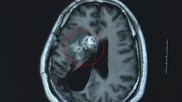 Un parásito estuvo comiéndose su cerebro durante 15 años.