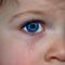 Retinoblastoma, el cáncer de ojo que afecta principalmente a niños pequeños
