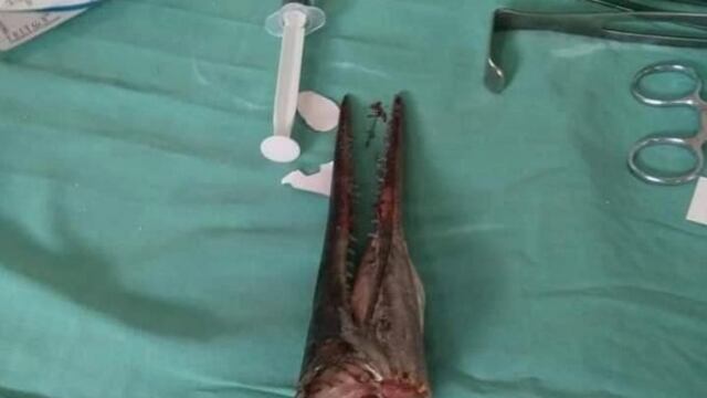 Joven se somete a cirugía para extraer el pez espada de su cuello