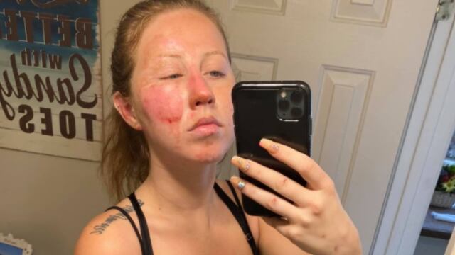 Turista quemada por mesero