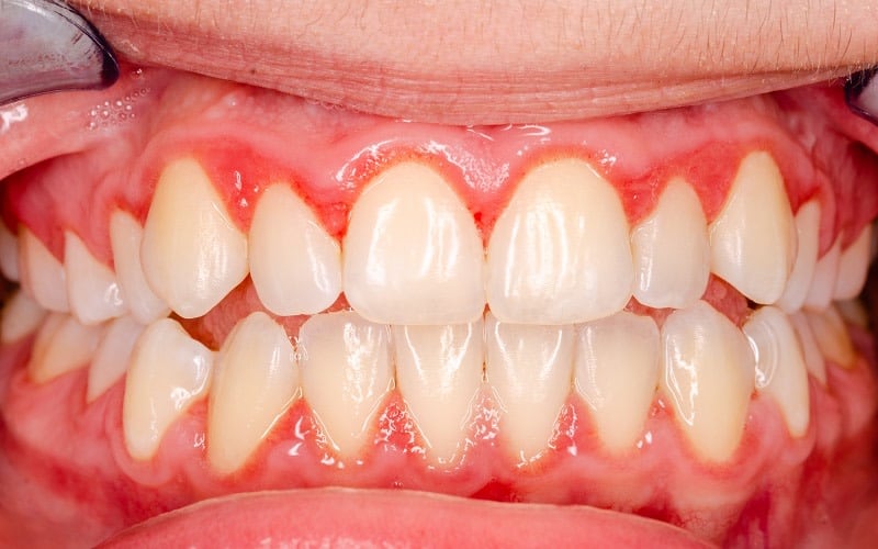 Periodontitis