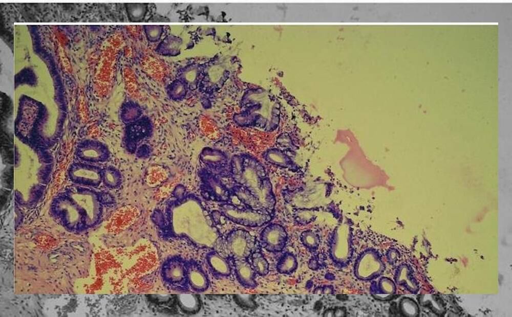 VPH a través del microscopio