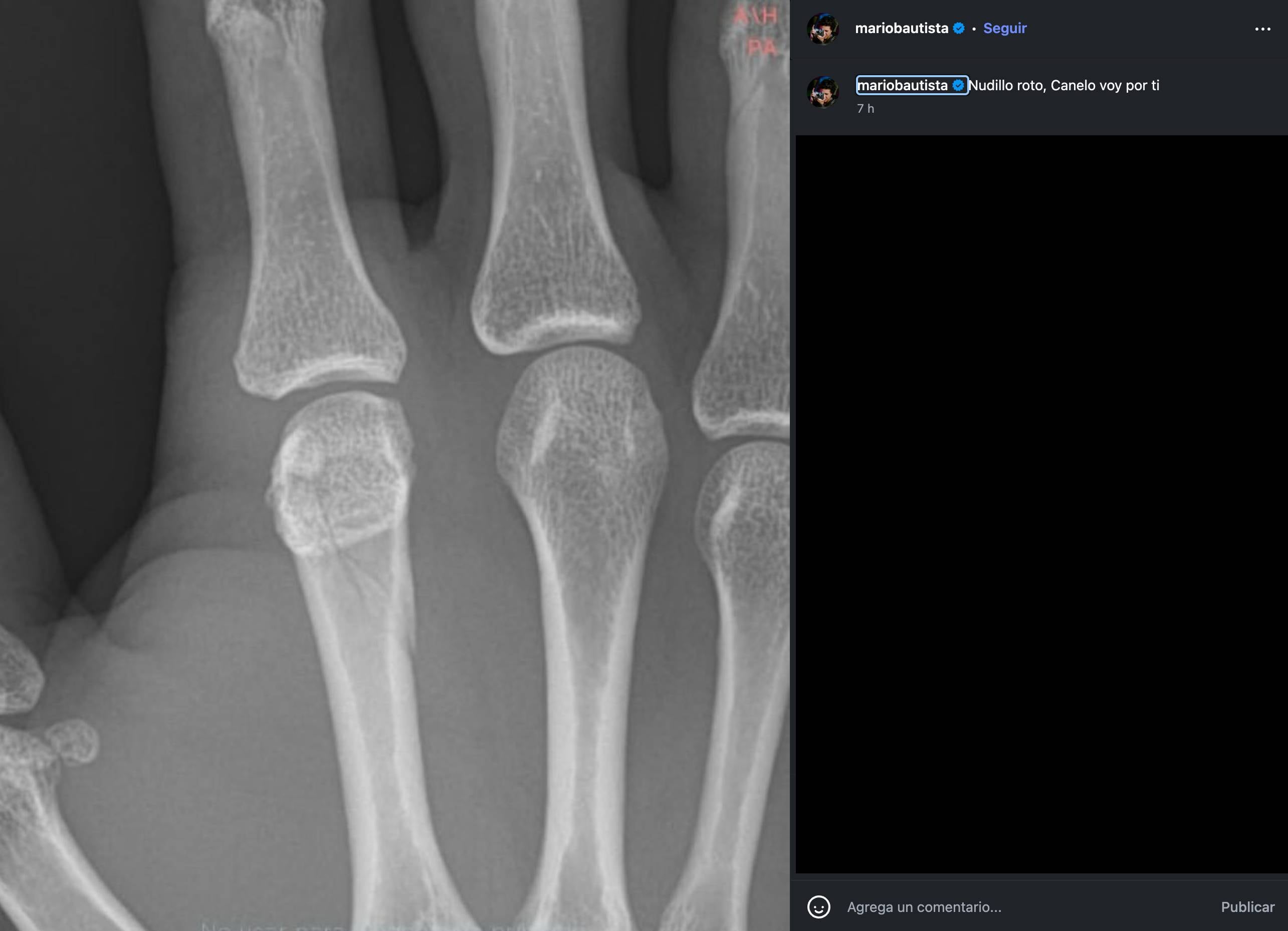 Mario Bautista tuvo una fractura tras pelear en Supernova Orígenes