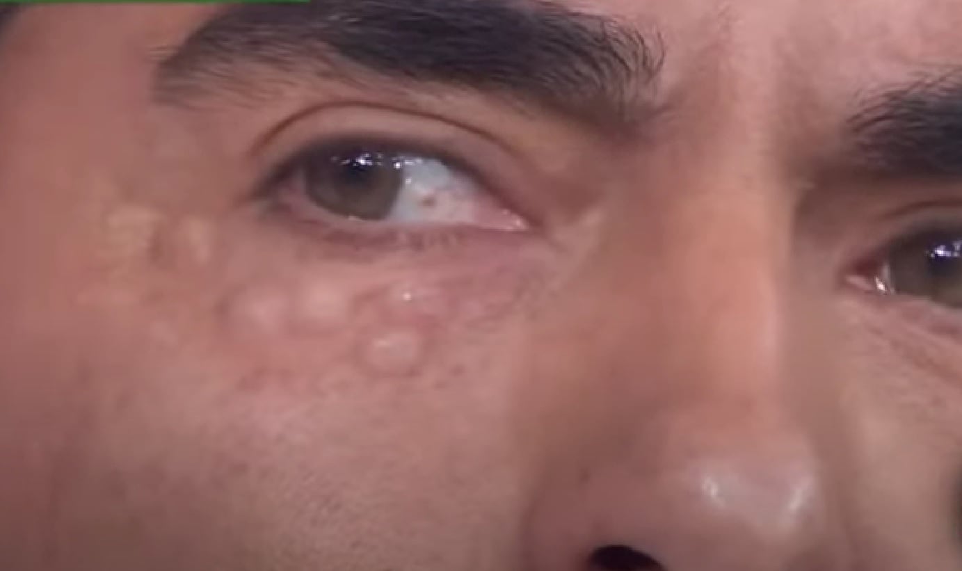 Raúl Araiza se somete a tratamiento de belleza que le desfigura el rostro