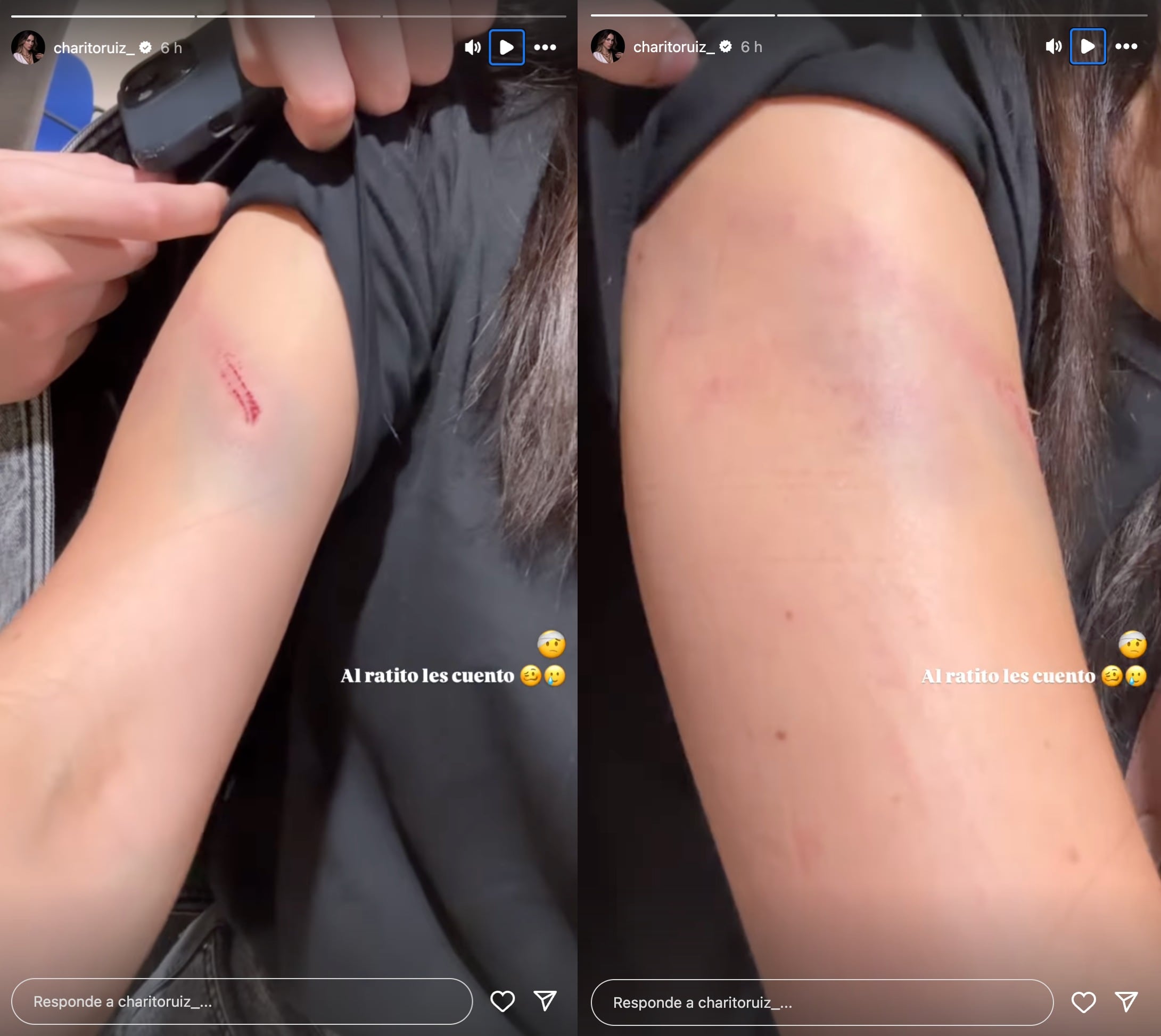 Charito Ruiz muestra golpe en el brazo y preocupa a sus seguidores